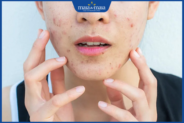 bị mụn nội tiết sau sinh