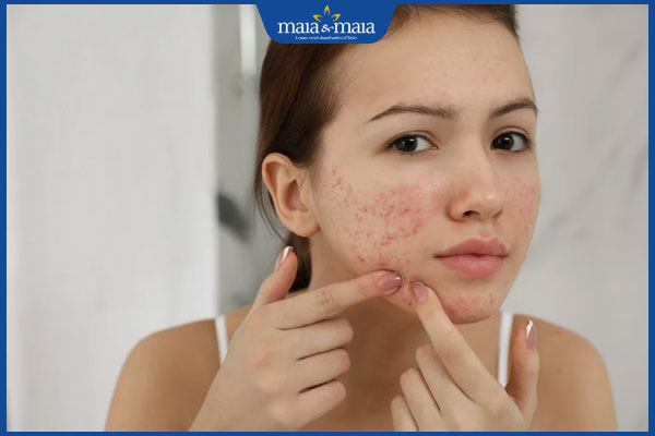 Bị mụn nội tiết có nên nặn không? Cách trị mụn dứt điểm 2 bị mụn nội tiết trên mặt