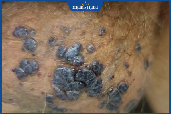 Nổi mụn ở tinh hoàn có nguy hiểm không? Chuyên gia tư vấn 3 biến chứng khi nổi mụn ở tinh hoàn