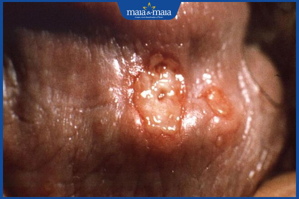 Mụn rộp sinh dục nam có nguy hiểm không? Điều trị ở đâu tốt? 6 biến chứng mụn rộp sinh dục nam