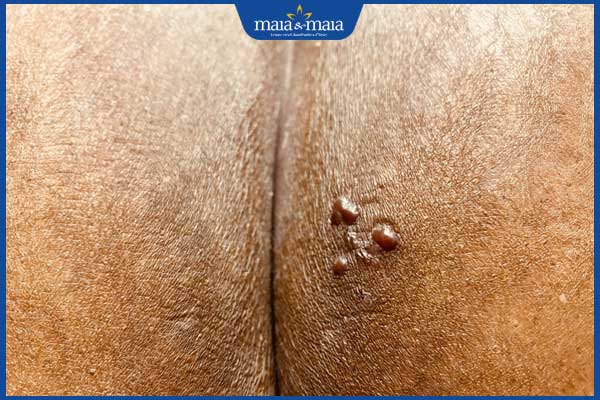 Mụn rộp sinh dục ở hậu môn do đâu? Điều trị như thế nào? 3 biến chứng mụn rộp sinh dục ở hậu môn