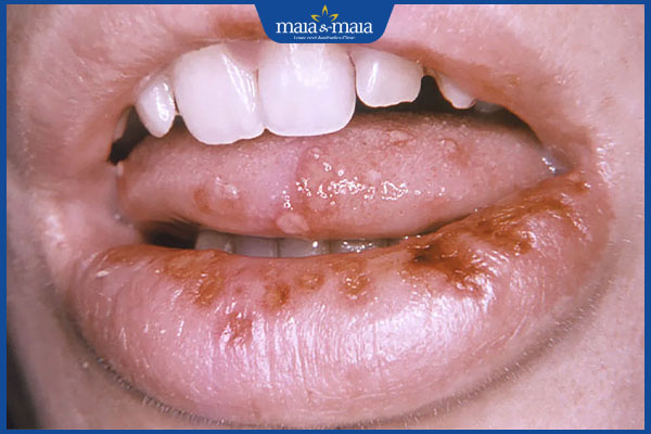 Mụn rộp sinh dục ở miệng có nguy hiểm không? 3 biến chứng mụn rộp sinh dục ở miệng