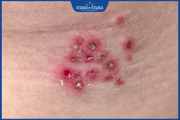 Zona thần kinh ở vùng kín có nguy hiểm không? Cách xử lý 4 biến chứng mụn rộp sinh dục