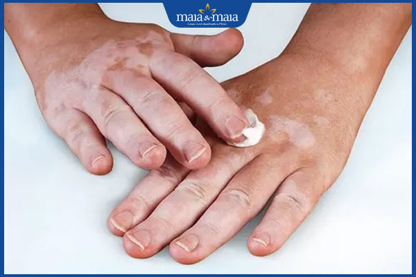 bôi kem lên đốm trắng