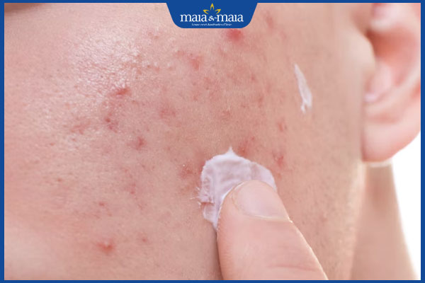 bôi kem lên mụn dị ứng