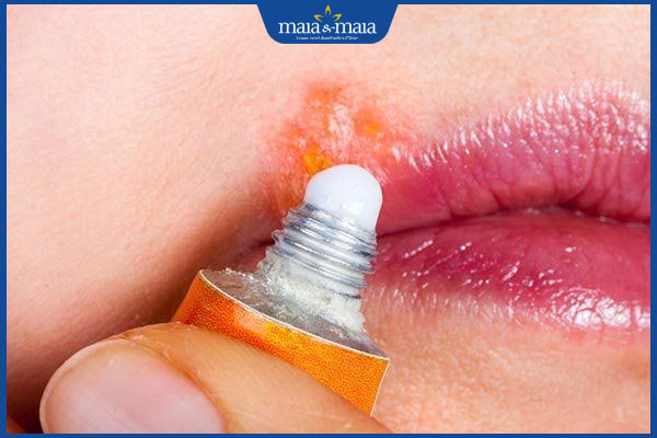 Mụn rộp sinh dục ở miệng có nguy hiểm không? 4 bôi mụn rộp sinh dục ở miệng