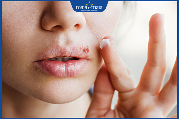 bôi thuốc vào vảy mụn