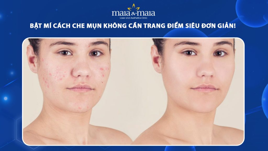 cách che mụn không cần trang điểm
