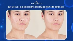 cách che mụn không cần trang điểm