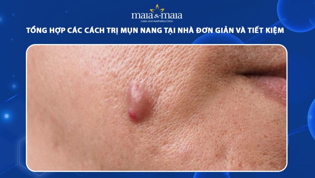 Tổng hợp 8 cách trị mụn nang tại nhà đơn giản và tiết kiệm 1 cách trị mụn nang tại nhà