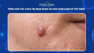 cách trị mụn nang tại nhà