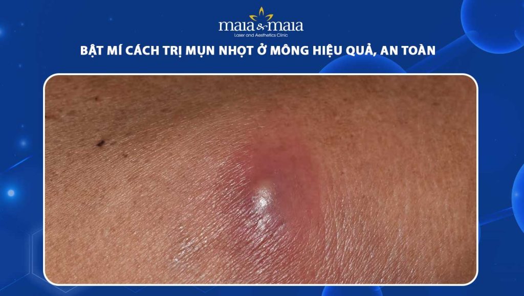 Bật mí các cách trị mụn nhọt ở mông hiệu quả, an toàn 1 cách trị mụn nhọt ở mông