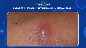 cách trị mụn nhọt ở mông
