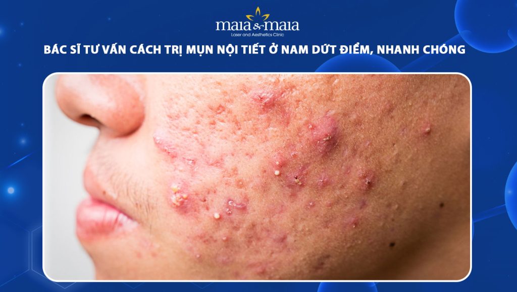 Bác sĩ tư vấn cách trị mụn nội tiết ở nam dứt điểm, hiệu quả 1 cách trị mụn nội tiết ở nam
