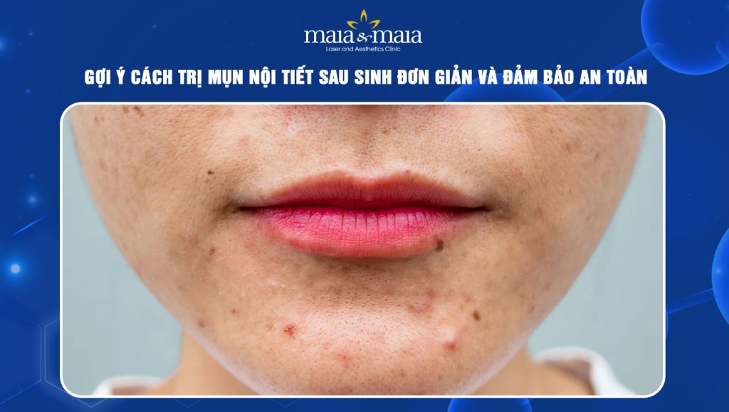 Cách trị mụn nội tiết sau sinh