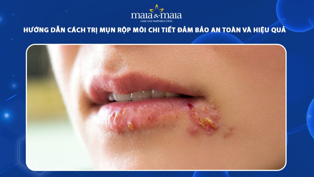 cách trị mụn rộp môi