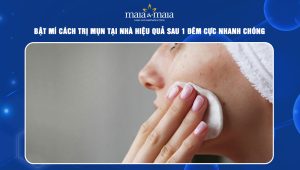 cách trị mụn tại nhà hiệu quả sau 1 đêm