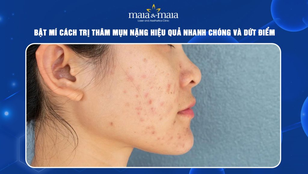 Cách trị thâm mụn nặng hiệu quả nhanh chóng và dứt điểm 1 cách trị thâm mụn nặng