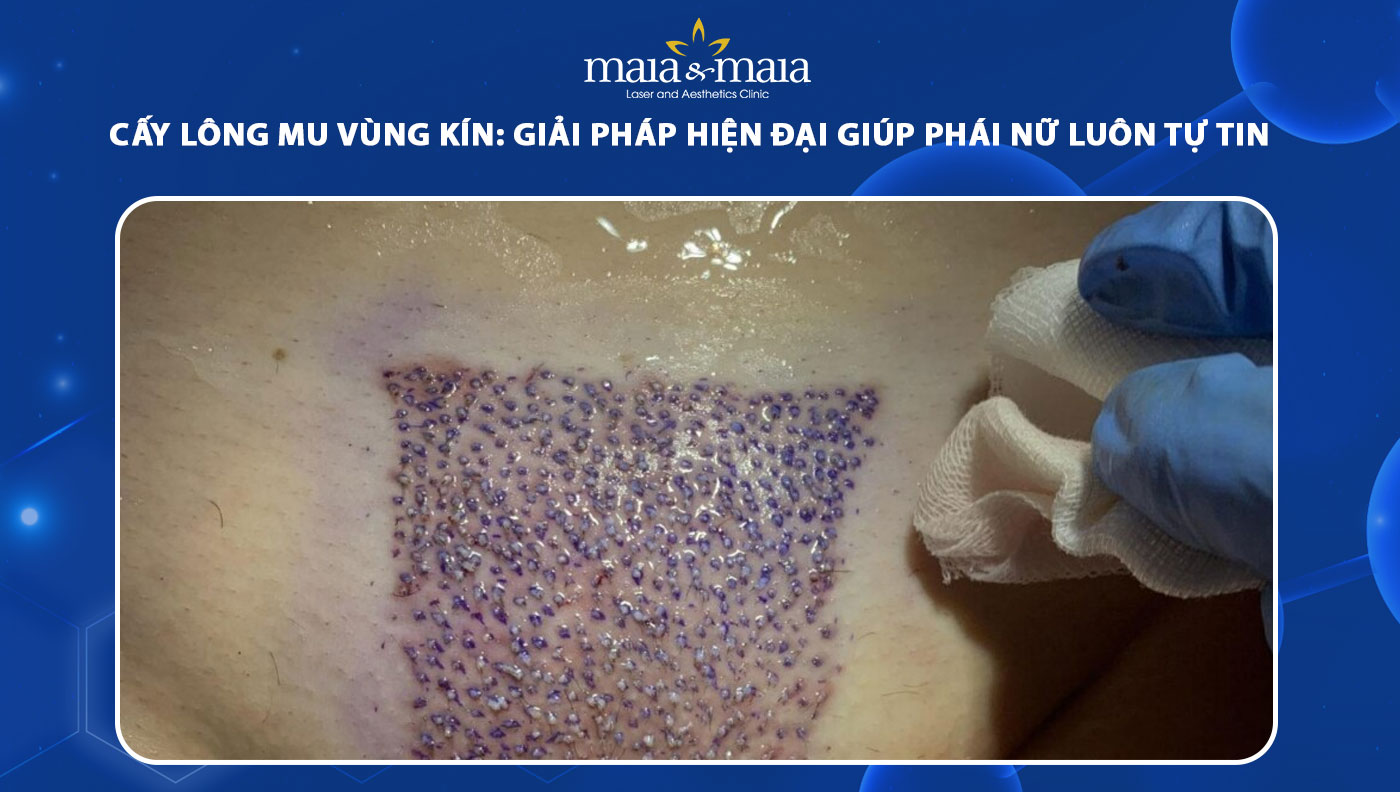 Yu Long Mu Cấy lông mu là gì? Quy trình, lợi ích và lưu ý quan trọng