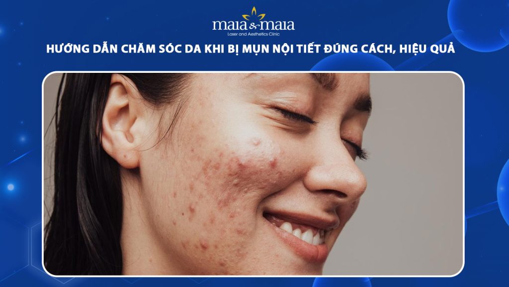 chăm sóc da khi bị mụn nội tiết