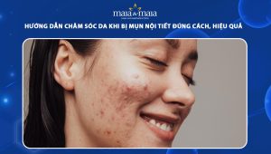 chăm sóc da khi bị mụn nội tiết