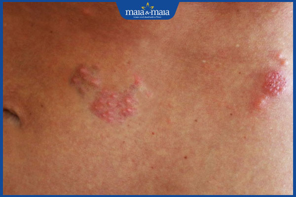 chữa mụn rộp sinh dục sớm