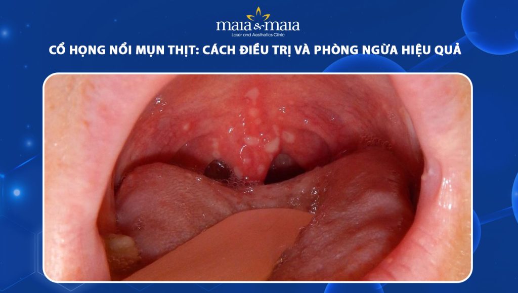 cổ họng nổi mụn thịt