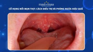 cổ họng nổi mụn thịt