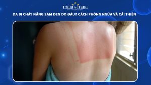 da bị cháy nắng sạm đen