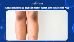 da chân bị sạm đen