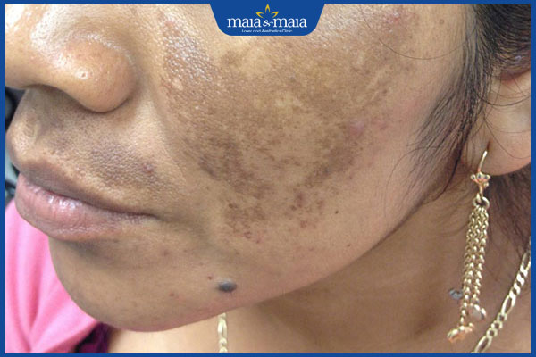 da mặt bị sạm đen