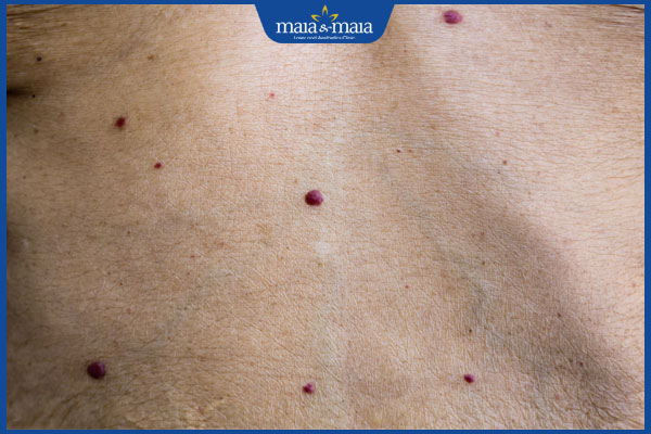 da nổi chấm đỏ nhiều