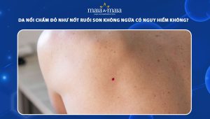 da nổi chấm đỏ như nốt ruồi son không ngứa