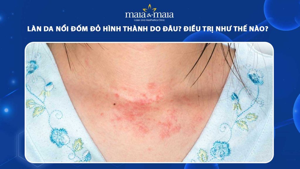 Làn da nổi đốm đỏ hình thành do đâu? Điều trị như thế nào? 1 da nổi đốm đỏ