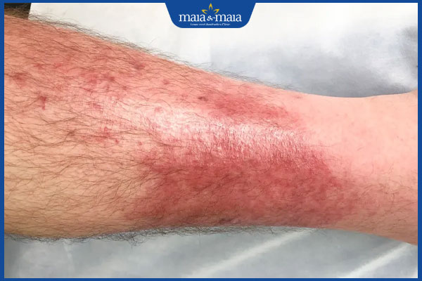 Làn da nổi đốm đỏ hình thành do đâu? Điều trị như thế nào? 4 da nổi đốm đỏ lan rộng