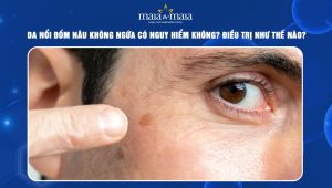 da nổi đốm nâu không ngứa