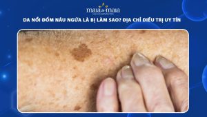 da nổi đốm nâu ngứa