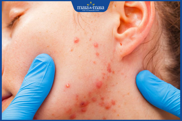 Mụn nội tiết ở quai hàm: Nguyên nhân, cách điều trị dứt điểm 2 đặc điểm mụn nội tiết ở quai hàm