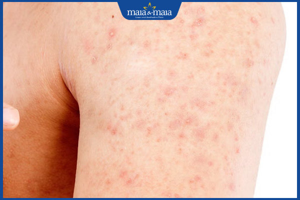 Mụn ở bắp tay do đâu? Các phương pháp điều trị hiệu quả 2 dấu hiệu mụn bắp tay