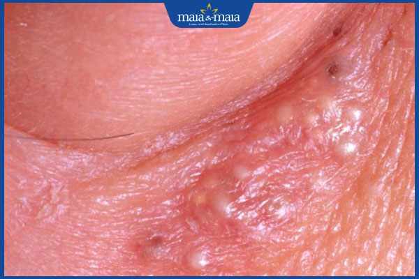 dấu hiệu mụn đầu trắng ở vùng kín