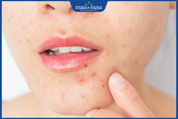 Mụn nội tiết ở cằm là như thế nào? Cách điều trị hiệu quả 2 dấu hiệu mụn nội tiết ở cằm