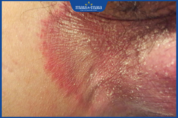 Dương vật nổi mụn đỏ là bệnh lý gì? Địa chỉ thăm khám uy tín 2 dấu hiệu nổi mụn đỏ dương vật