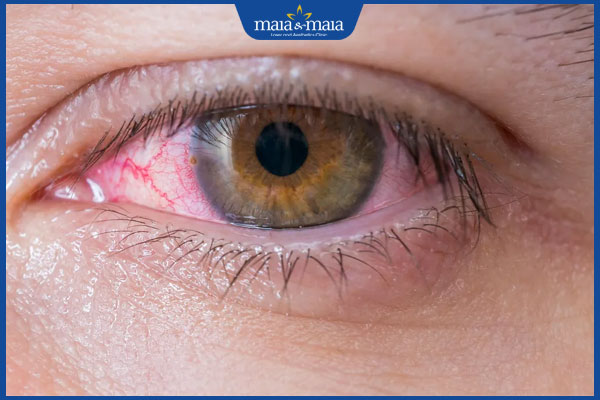 Mụn rộp ở mắt: Nguyên nhân, cách điều trị và phòng ngừa 6 đau mắt đỏ