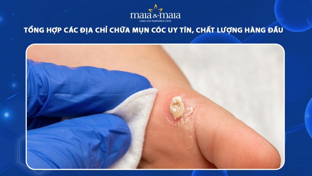 Tổng hợp 5 địa chỉ chữa mụn cóc uy tín, chất lượng hàng đầu 1 địa chỉ chữa mụn cóc