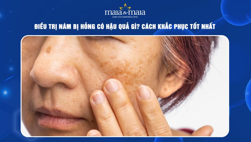 điều trị nám bị hỏng