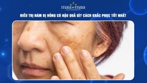 điều trị nám bị hỏng