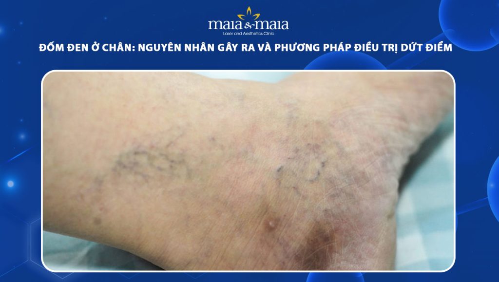 đốm đen ở chân