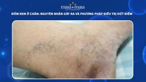 đốm đen ở chân