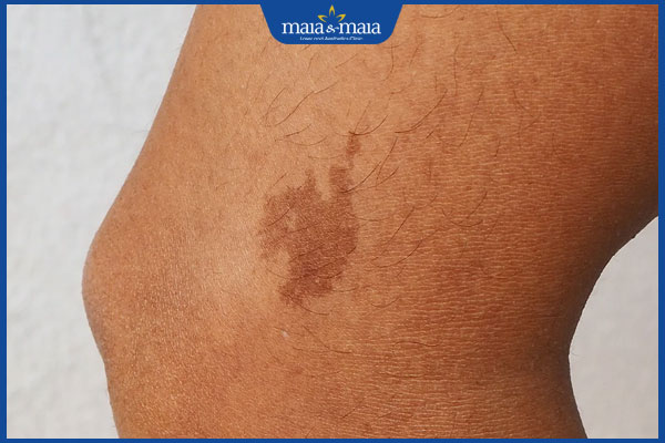 đốm đen sạm ở chân