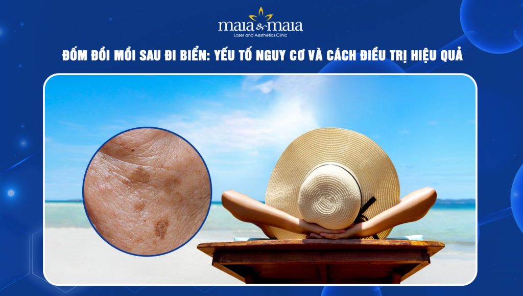 đốm đồi mồi sau đi biển